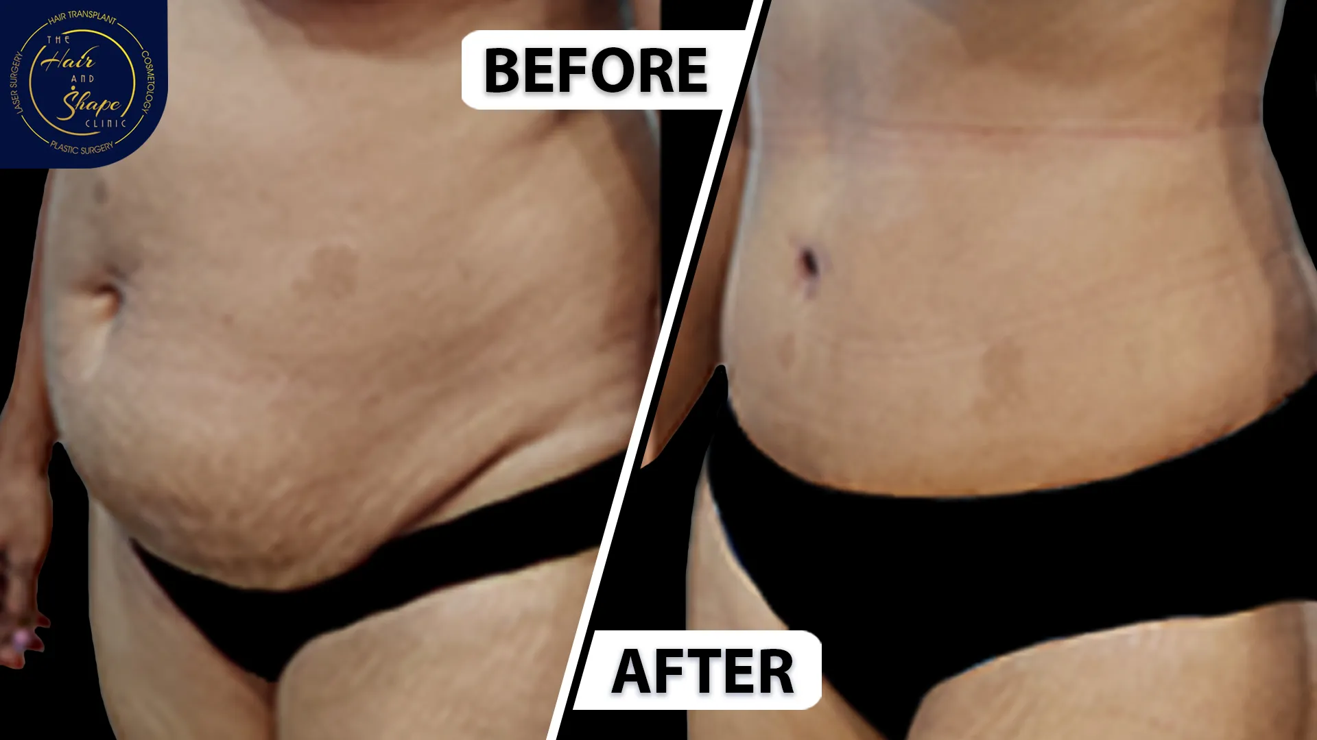 Tummy Tuck result9
